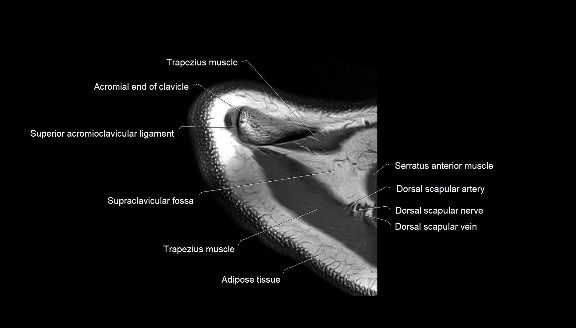 Shoulder cross sectional anatomy MRI 3T axial image 4.webp